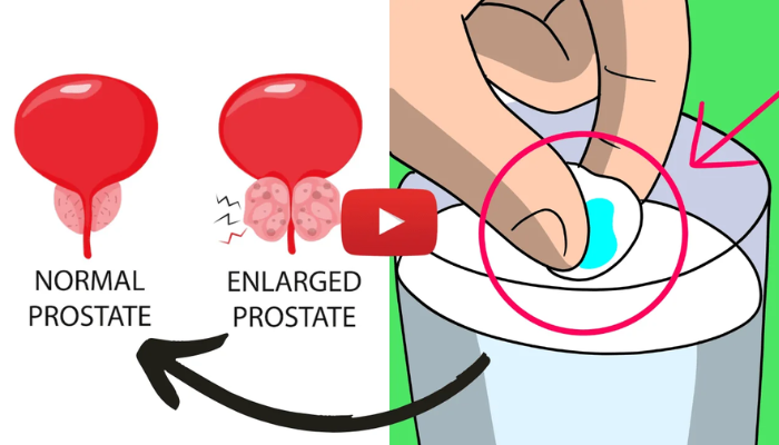 prostate enlarged